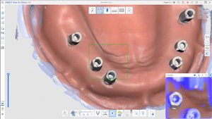 Easy Edentulous Scanning Using Scan Body (Replicate Existing Data)