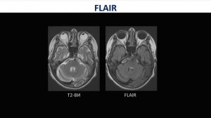 базовые последовательности: FLAIR