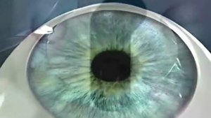 Лазерная коррекция зрения ЛАСИК