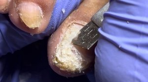 Super thick yellow onychomycosis, use pliers to remove the hard part【Doctor Liu Pedicure】