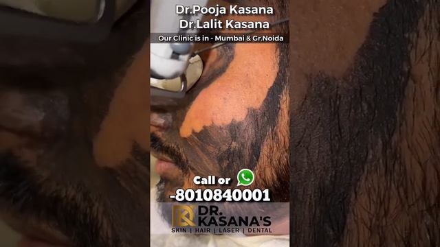 CARBON LASER PEEL Before and After смотреть онлайн