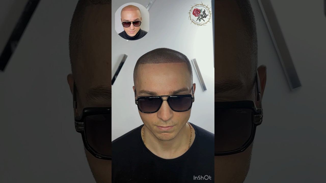 Загущение волос после пересадки с помощью трихопигментации. Scalp micropigmentation SMP