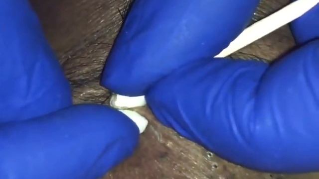 ЧЕРНЫЕ ТОЧКИ ДАВИТЬ ЗАЛЕПАТЕЛЬНО