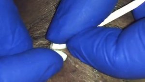 ЧЕРНЫЕ ТОЧКИ ДАВИТЬ ЗАЛЕПАТЕЛЬНО