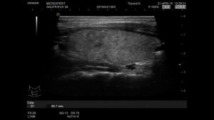 Диффузные изменения щитовидной железы