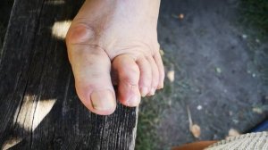 41. Отзыв. Уменьшился Халюс Вальгус - искривление большого пальца стопы