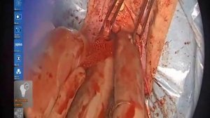 Цистоцеле 3ст. Передний Элевейт.