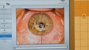 Имплантация интрастромального роговичного сегмента с фемтосопровождением