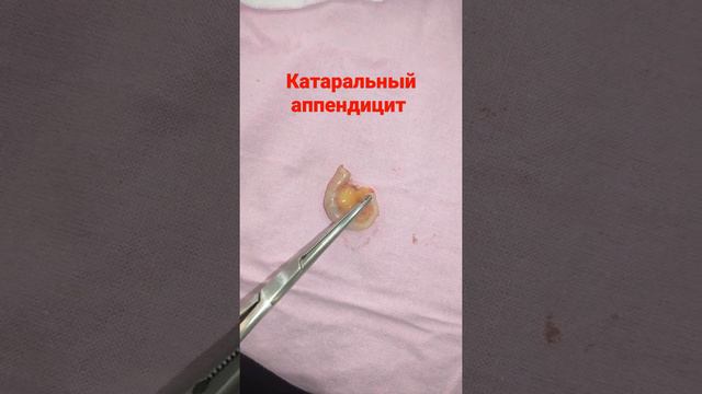 вот как выглядит катаральный аппендицит