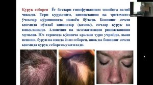 Себорея касаллиги