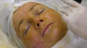 Постановка нитей EPITICON (Jetema, Южная Корея): лифтинг средней трети.