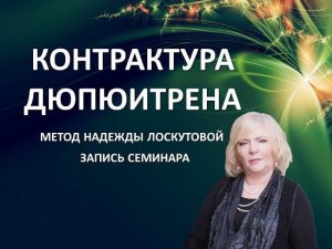 Контрактура Дюпюитрена