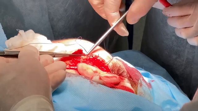 Удаление смешанной опухоли околоушной слюнной железы слева