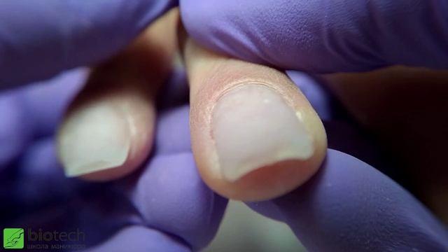 исправление клюющего ногтя все товары можно заказать на сайте https://www.biotechschool.ru/