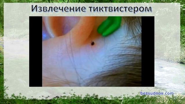 Что делать если укусил клещ смотреть онлайн