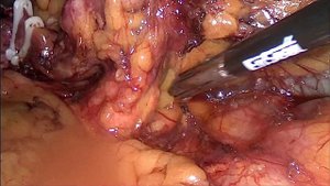 Видеолапароскопическая спленэктомия селезенки больших размеров