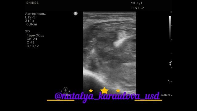 Что может симулировать тромбоз глубоких вен верхней конечности смотреть онлайн