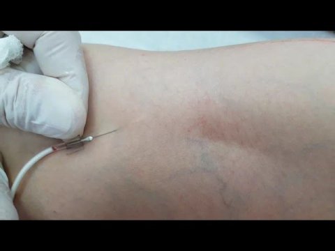 Процедура склеротерапия вен нижних конечностей