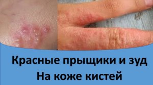 Красные прыщики и зуд на коже кистей