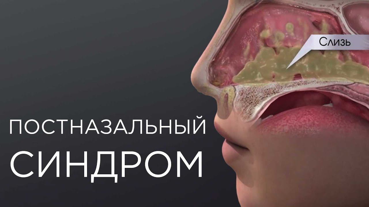 ПОЧЕМУ СТЕКАЕТ ПО ЗАДНЕЙ СТЕНКЕ ГОРЛА