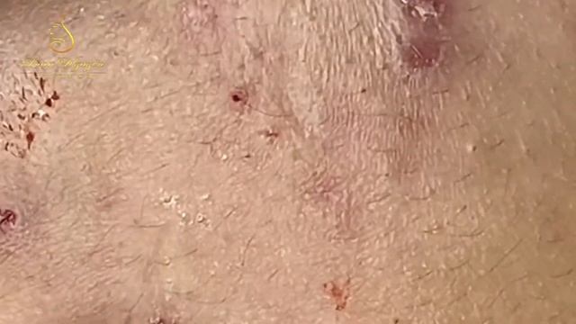 Professional bleckheads   Выдавливание черных точек прыщей   самое залипательное видео 2023