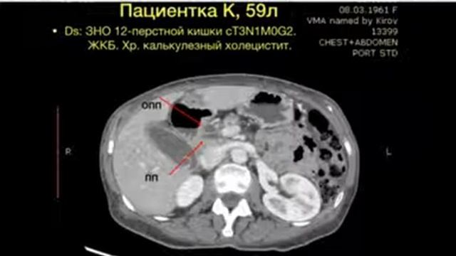 Клинический случай низкого впадения пузырного протока в общий печеночный проток смотреть онлайн