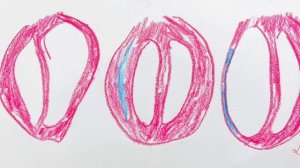 Аневризма сердца