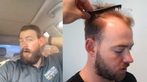 Male Baldness Hair Transplant Results 12 Months | Dr. Matt Huebner (Colton)