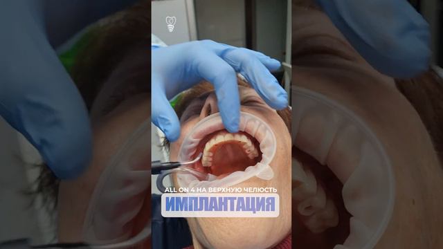 All on 4 на верхнюю челюсть. All on 4 on the upper jaw. Implantation.