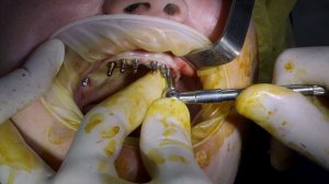 Базальная имплантация Monoimplant