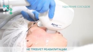 УДАЛИТЬ СОСУДЫ НА ЛИЦЕ Сеть клиник косметологии GEN87