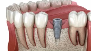 Установка зубного имплантата, специального абатмента и керамической коронки