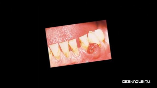 Нарост на десне. Причины, виды, симптомы и лечение смотреть онлайн