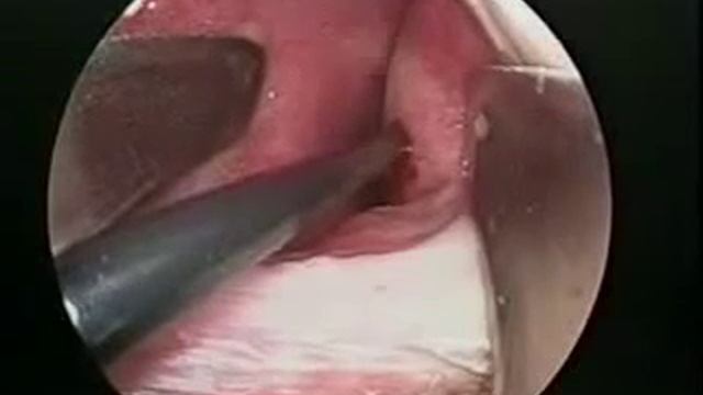 Лечение вазомотора плазмой.mp4 смотреть онлайн