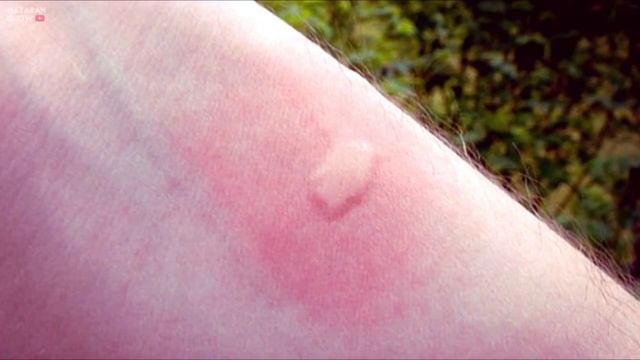 ЧТО БУДЕТ ЕСЛИ УКУСИЛ ОВОД ИЛИ СЛЕПЕНЬ смотреть онлайн