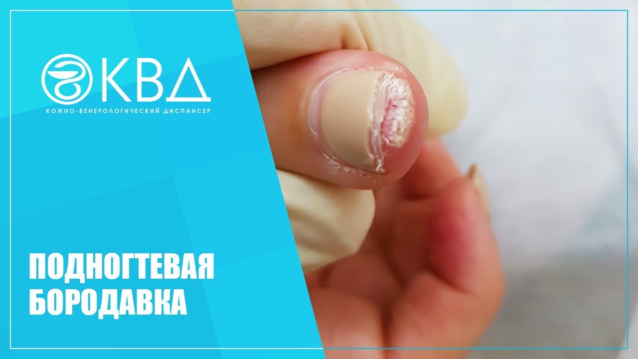 Подногтевая бородавка. Клинический случай №109