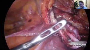 Герниоклуб 1 ТАРР паховая грыжа, золотые правила IHR