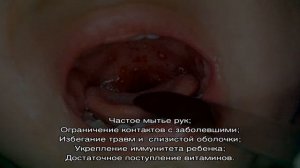 Лечение герпесного стоматита у ребенка