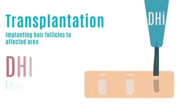 Пересадка волос в Турции | Hairtransplantant смотреть онлайн