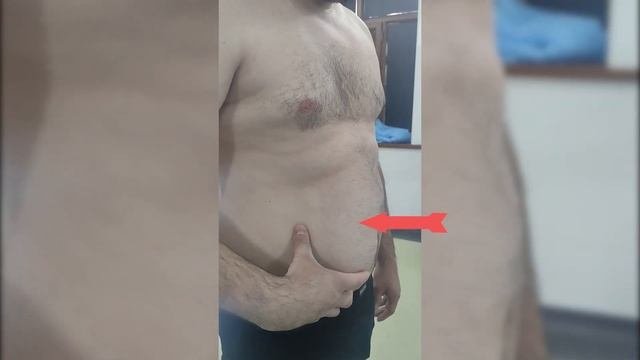 Lipomani Olib Tashlash. Удаление липомы передней брюшной стенки живота.