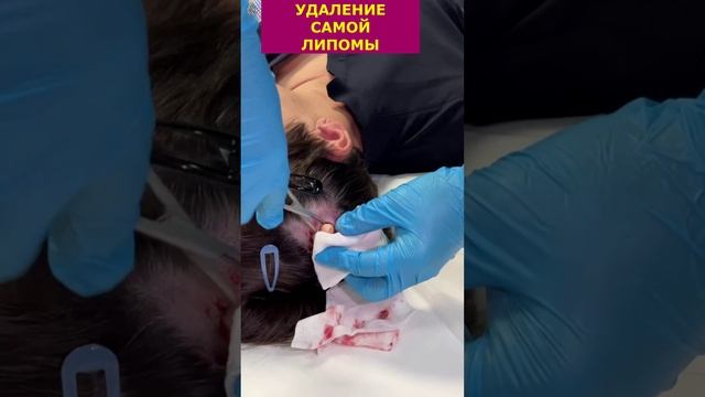 Липома. Удаление смотреть онлайн