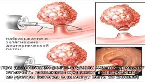 Полипы в мочевом пузыре