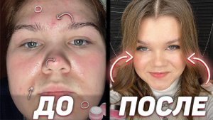 КАК Я ИЗБАВИЛАСЬ ОТ ПРЫЩЕЙ ?