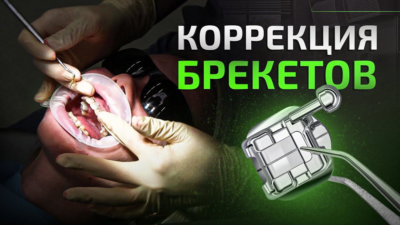 Активация брекетов на реальном пациенте. Ортодонтическое лечение | LIFE