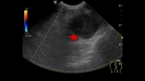 УЗИ при аневризме подколенной вены