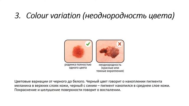 Родинка или меланома? Признаки злокачественного новообразования кожи