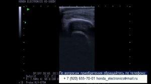 Ректальное исследование коров на  узи-сканере Honda HS-1600V  - Эндометрит. Желтого тела нет.