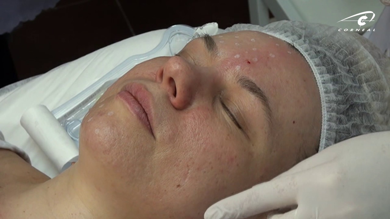 Биоревитализация обучение. Опасные зоны для инъекций. смотреть онлайн