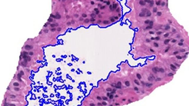 Expectation-Maximization driven Level Set Model for Gland Segmentation on Prostate Histology Images смотреть онлайн