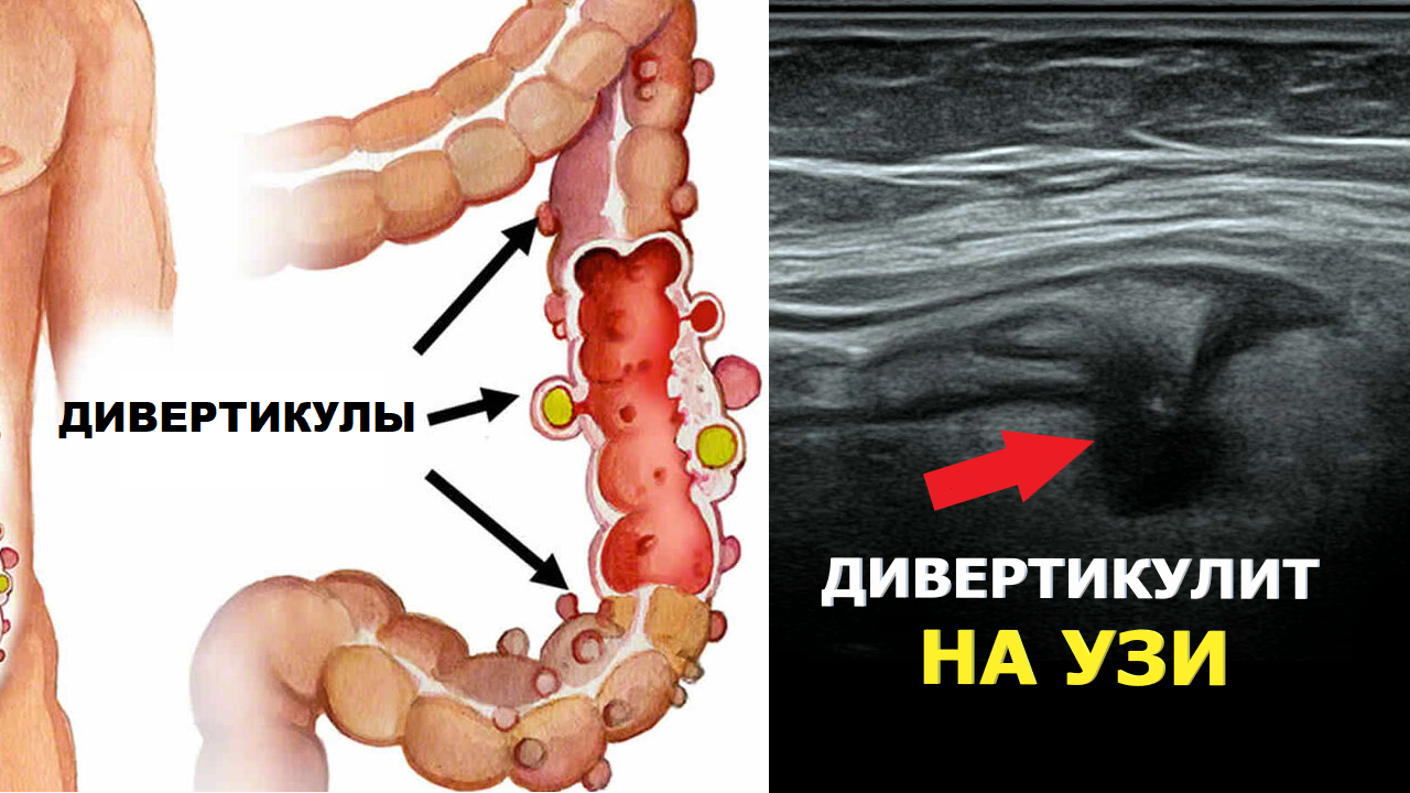 Как выглядит ДИВЕРТИКУЛИТ на УЗИ?